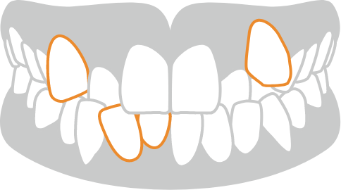 ガタガタした歯並びや八重歯（叢生）