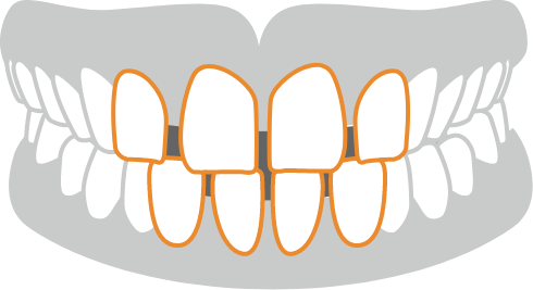 すきっ歯（空隙歯列）